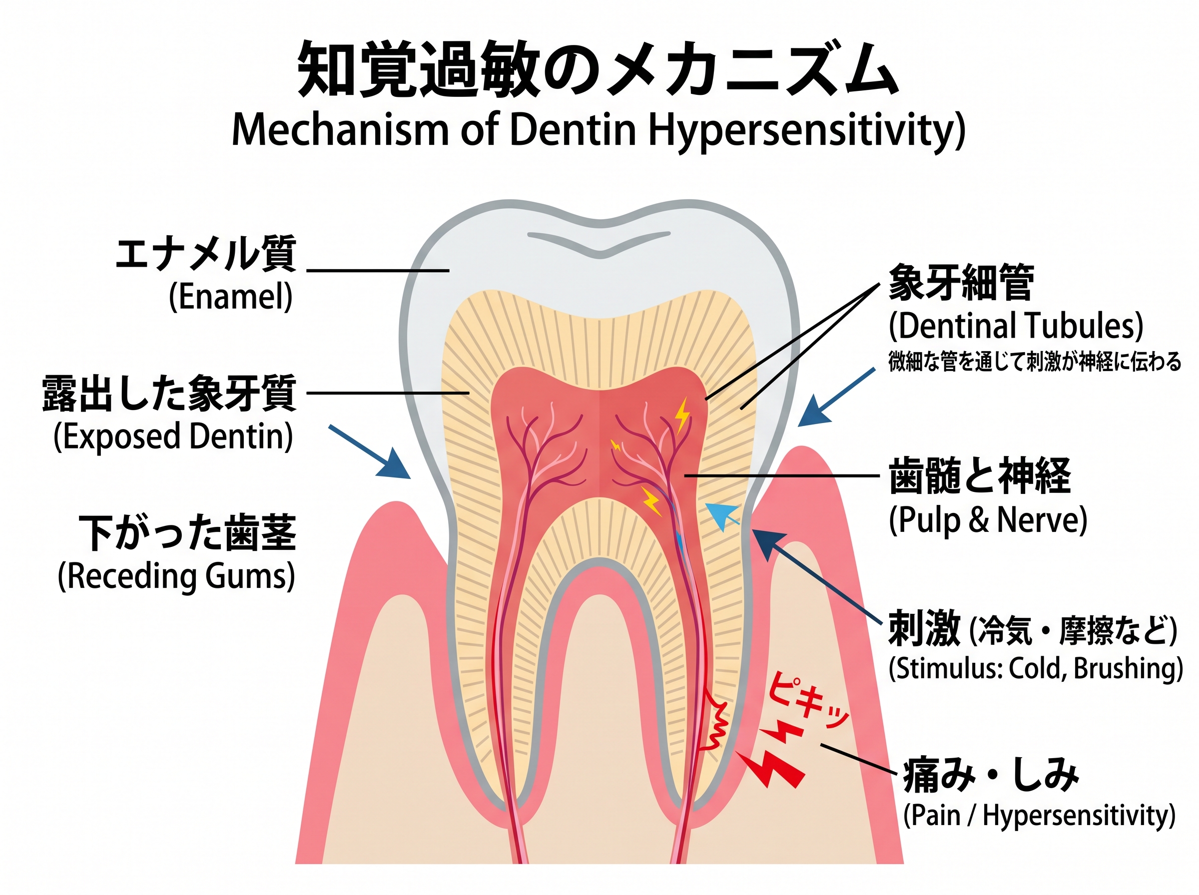 知覚過敏症に突入